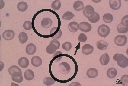 <strong> The cells circled below show an eccentric puddling of their hemoglobin contents.This is most closely associated with:</strong> A) Stomatocytosis B) Xerocytosis C) G6PD deficiency D) Pyruvate kinase deficiency