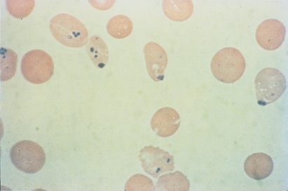<strong> The inclusions pictured below are seen with supravital staining only.These inclusions are most likely:</strong> A) Heinz bodies B) Howell-Jolly bodies C) Pappenheimer bodies D) Due to stain contamination