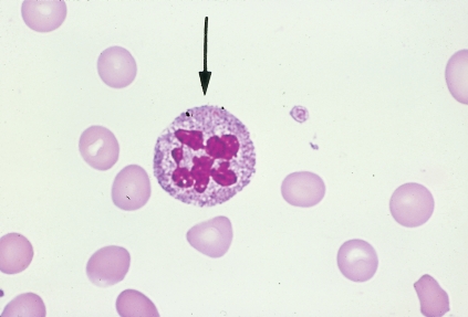 <strong> The cell pictured above may be seen in which of the following conditions?</strong> A) Iron deficiency anemia B) Megaloblastic anemia C) Thalassemia major D) Hereditary hemochromatosis