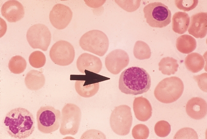 <strong> The stage of development of the cell at the end of the pointer is:</strong> A) Polychromatophilic normoblast B) A reticulocyte C) A rubricyte D) An orthochromatic normoblast