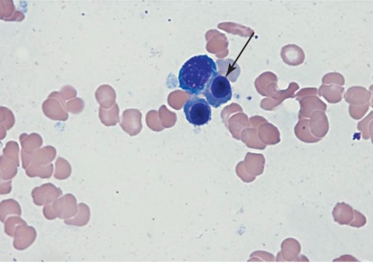 <strong> Describe the hemoglobin content of the cell at the end of the pointer.</strong> A) Normochromic B) Hypochromic C) Polychromatophilic D) Hyperchromic