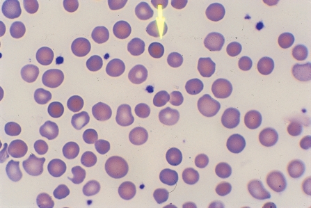 <strong> Identify the cell at the end of the pointer.</strong> A) Spherocyte B) Schistocyte C) Acanthocyte D) Normocyte