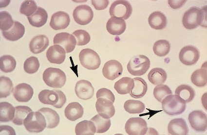 <strong> Identify the cell at the end of the pointers.</strong> A) Reticulocyte B) Spherocyte C) Sickle cell D) Target cell