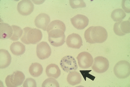 <strong> The term used to describe the inclusions seen in the cell at the end of the pointer is (Wright's stain):</strong> A) Pappenheimer bodies B) Basophilic stippling C) Howell Jolly bodies D) Siderotic granules