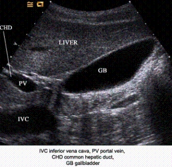 Describe the orientation of the major structures in this sagittal scanning plane image just to the right of the midline of the body. a. ____________ section of the IVC b. ____________ section of the PV c. ____________ section of the CHD d. ____________ section of the GB e. ____________ section of the liver