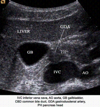 Describe the orientation of the major structures in this transverse scanning plane image just to the right of the midline of the body. a. ________ section of the IVC b. ________ section of the AO c. ________ section of the GB d. ________ section of the CBD e. ________ section of the GDA f. ________ section of the PH g. ________ section of the liver