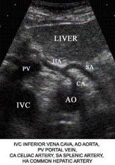 Describe the orientation of the major structures in this transverse scanning plane image of the upper epigastrium. a. ________ section of the IVC b. ________ section of the AO c. ________ section of the CA d. ________ section of the SA e. ________ section of the HA f. ________ section of the liver