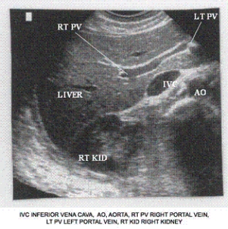 Describe the orientation of the major structures in this transverse scanning plane image of the right upper quadrant. a. ________ section of the IVC b. ________ section of the AO c. ________ section of the RT KID d. ________ section of the RT PV e. ________ section of the LT PV f. ________ section of the LIVER