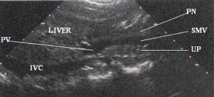 Describe the orientation of the major structures in this sagittal scanning plane image just to the right of the midline of the body. a. ________ section of the IVC b. ________ section of the PN c. ________ section of the SMV d. ________ section of the UP e. ________ section of the LIVER