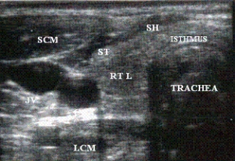 Describe the orientation of the major structures in this transverse scanning plane image just to the right of the midline of the neck. a. ________ section of the RT L b. ________ section of the CCA c. ________ section of the JV d. ________ section of the LCM e. ________ section of the ST f. ________ section of the SH g. ________ section of the SCM h. ________ section of the TRACHEA i. ________ section of the ISTHMUS