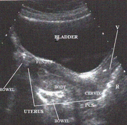 Describe the orientation of the major structures in this sagittal scanning plane image at the midline of the pelvis. a. ________ section of the UTERUS b. ________ section of the VAGINA c. ________ section of the BLADDER