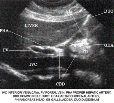 Using the image below, describe the anatomic relationship of the portal vein to adjacent structures.