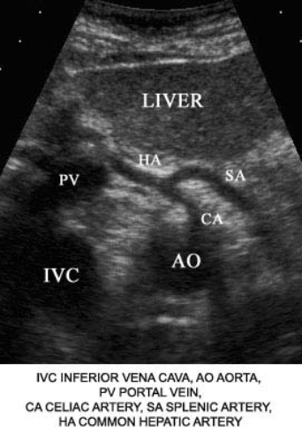 Using the image below, describe the anatomic relationship of the hepatic artery to adjacent structures.