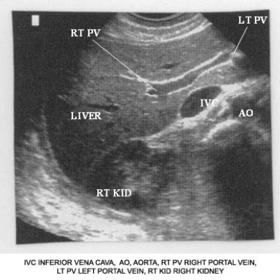 Using the image below, describe the anatomic relationship of the inferior vena cava to adjacent structures.