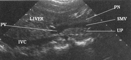 Using the image below, describe the anatomic relationship of the superior mesenteric vein to adjacent structures.