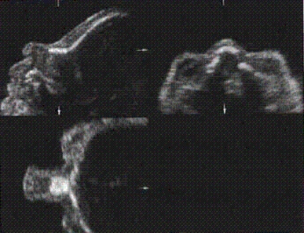 Identify the original acquisition plane for this image of the fetal nasal bone. What do the other two planes represent?