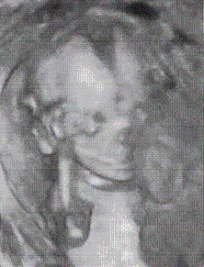 Compare the difference in the fetal appearance in Figures A and B.