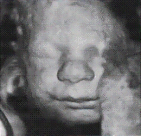 Compare the difference in the fetal appearance in Figures A and B.