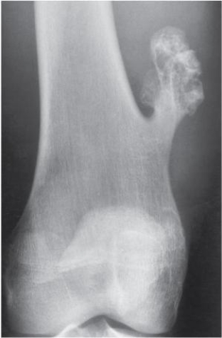 <strong>Refer to the image below.Notice the tumor grows parallel to the bone and points away from the adjacent joint.Which common benign bone tumor is demonstrated with this image? </strong> A) Osteochondroma. B) Osteoid osteoma. C) Osteoclastoma. D) Osteogenic sarcoma.