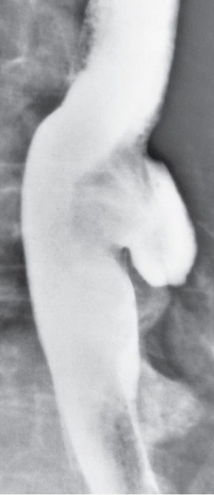 <strong>Refer to the image.What esophageal pathologic condition is demonstrated? From Eisenberg RL: Gastrointestinal radiology: a pattern approach,Philadelphia,1990,Lippincott.</strong> A) Varices. B) Hiatal hernia. C) Barrett's esophagus. D) Esophageal diverticulum.