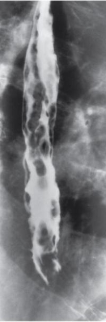 <strong>Refer to the image.This esophageal pathologic condition is described as resembling beads on a rosary.What pathologic condition is evident in this image? </strong> A) Varices. B) Hiatal hernia. C) Esophageal diverticula. D) Gastric ulcer.