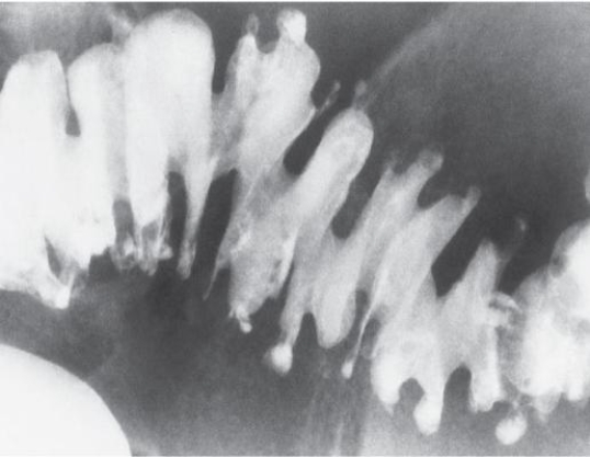 <strong>Refer to the image below.This typical saw-tooth configuration demonstrated on a barium enema exam is evidence of </strong> A) ulcerative colitis B) diverticulosis C) appendicitis D) intussusception
