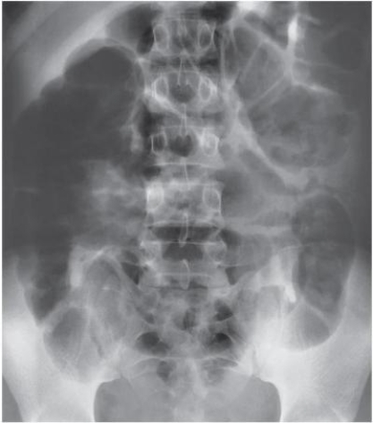 <strong>Refer to the image.This disorder is caused by a loss of bowel motility.What disorder is demonstrated in this abdominal radiograph? </strong> A) Mechanical obstruction. B) Adynamic ileus. C) Volvulus. D) Intussusception.