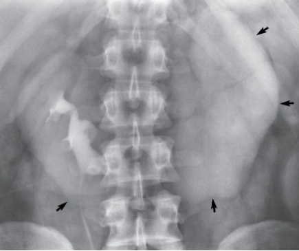 <strong>Refer to the image below.What developmental anomaly is demonstrated? </strong> A) Crossed ectopia. B) Horseshoe kidney. C) Unilateral renal agenesis. D) Supernumerary kidney.