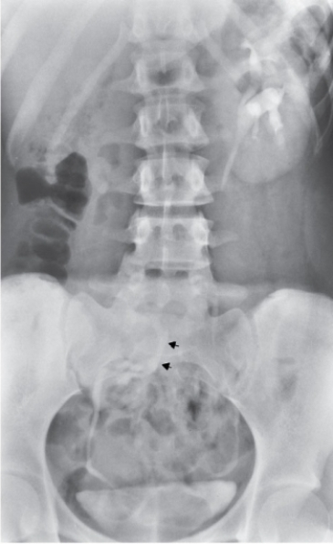 <strong>Refer to the image.Note the arrows.What condition is indicated by the arrows in this image of an intravenous urogram? </strong> A) Ureterocele. B) Kidney agenesis. C) Ectopic kidney. D) Hypertrophic kidney.