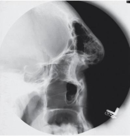 <strong>Which disease is evidenced in the radiograph below?  </strong> A) Goiter. B) Gigantism. C) Acromegaly. D) Hypopituitarism. <div style=padding-top: 35px> 