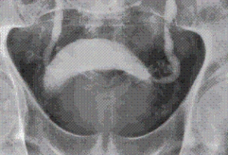 <strong>Refer to the image below obtained during an excretory urogram on a male patient.What condition is indicated in this image?  </strong> A) Testicular torsion. B) Benign prostatic hyperplasia. C) Epididymitis. D) Testicular tumor. <div style=padding-top: 35px> 