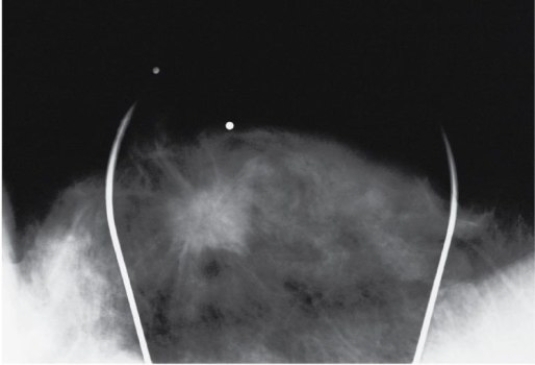 <strong>Refer to the image below.This magnified compression spot of a mammogram demonstrates the characteristic appearance of a  </strong> A) simple cyst B) calcific adenoma C) fibrocystic lesion D) breast malignancy <div style=padding-top: 35px> 