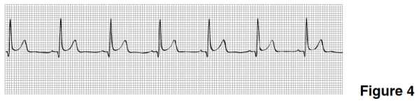 <strong>The rhythm in Figure 4 is </strong> A)Sinus rhythm. B)Sinus bradycardia. C)Sinus rhythm with sinus arrest. D)Sinus tachycardia.