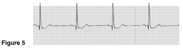 <strong>In Figure 5,the rhythm shown is </strong> A)Sinus rhythm. B)Sinus bradycardia. C)Sinus tachycardia. D)Sinus block.