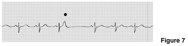 <strong>The rhythm in Figure 7 is </strong> A)Sinus rhythm with a sinus arrest and a junctional escape beat. B)Sinus arrhythmia. C)Sinus rhythm with a nonconducted PAC. D)Wandering atrial pacemaker.