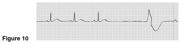 <strong>The rhythm in Figure 10 is </strong> A)Sinus rhythm with occasional PACs. B)Sinus bradycardia with PVC. C)Sinus rhythm with a sinus arrest and a ventricular escape beat. D)Idioventricular rhythm.