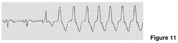 <strong>The rhythm in Figure 11 is </strong> A)Atrial fibrillation. B)Atrial flutter. C)Sinus rhythm with a burst of PAT. D)Sinus rhythm converting to ventricular tachycardia.