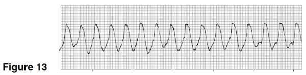 <strong>The rhythm in Figure 13 is </strong> A)Atrial flutter. B)Ventricular fibrillation. C)Atrial tachycardia. D)Ventricular tachycardia.