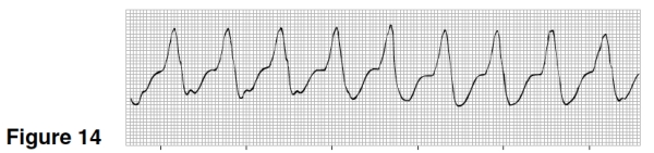 <strong>The heart rate in Figure 14 is closest to </strong> A)150. B)100. C)75. D)60.