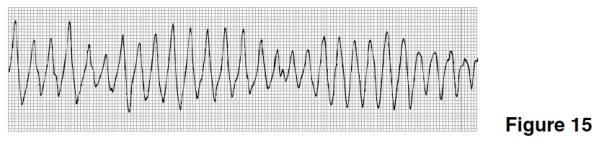 <strong>The rhythm in Figure 15 is </strong> A)Agonal rhythm. B)Ventricular tachycardia. C)Torsades de pointes. D)Ventricular fibrillation.