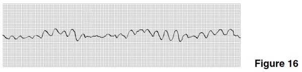 <strong>Treatment for the rhythm in Figure 16 would include which of the following? </strong> A)Electrical shock to the heart B)Atropine C)Digitalis D)Oxygen removal