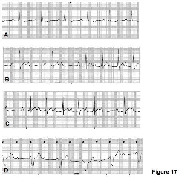 <strong>Which strip in Figure 17 is consistent with Mobitz I second-degree AV block (Wenckebach)? </strong> A)A B)B C)C D)D