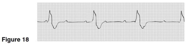 <strong>The PR interval in Figure 18 </strong> A)Is constant. B)Varies. C)Is about 0.12 seconds. D)Is about 0.20 seconds.