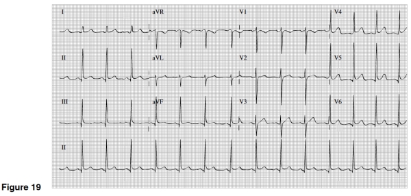 <strong>There is evidence of which of the following in Figure 19? </strong> A)Slight ST segment elevation in multiple leads B)Significant Q waves in II,III,and AVF C)Inverted T waves in V1-6 D)Widespread ST depression and T wave inversions