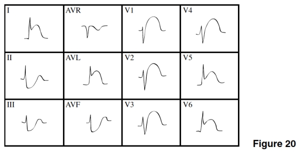 <strong>The age of the MI in Figure 20 is </strong> A)Acute. B)Age indeterminate. C)Old. D)Impossible to tell.