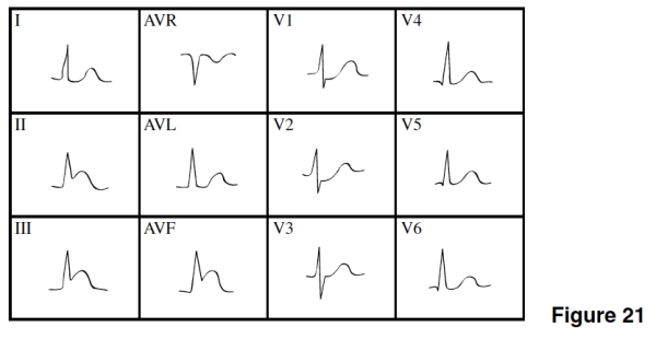 <strong>In Figure 21,there is evidence of </strong> A)Anterior wall ischemia. B)Anterior MI. C)NSTEMI. D)Inferior/posterior MI