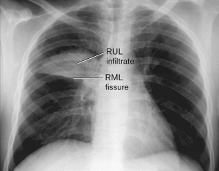 <strong>Using the figure below, what does RML stand for? </strong> A) right mediastinum lobe B) right lower lobe C) right middle lobe D) right upper lobe E) right middle lung