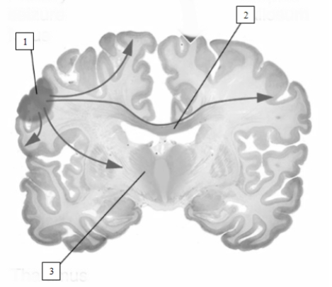 In this illustration,abnormal electrical activity travels from its origin,labeled number 1 or the ____________________ to the opposite hemisphere by way of the ____________________,which is labeled number 2.