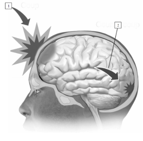<strong>see Figure 15.6 In this illustration of a closed head injury,the area indicated by the number 2 is known as a </strong> A)embolism. B)thrombosis. C)coup. D)countercoup.
