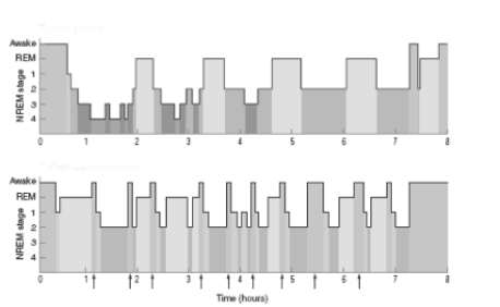 see Figure 16.17 -Compared to the sleep pattern of a healthy individual in the top image,the sleep pattern in the lower image features much more time spent in ____________________ and ____________________,but virtually no time in stages ____________________ and ____________________ of NREM sleep.